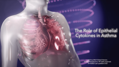 Asthma mechanisms of disease