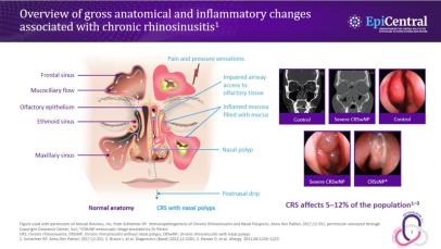 EAACI 2024 The role of epithelial cytokines in CRS