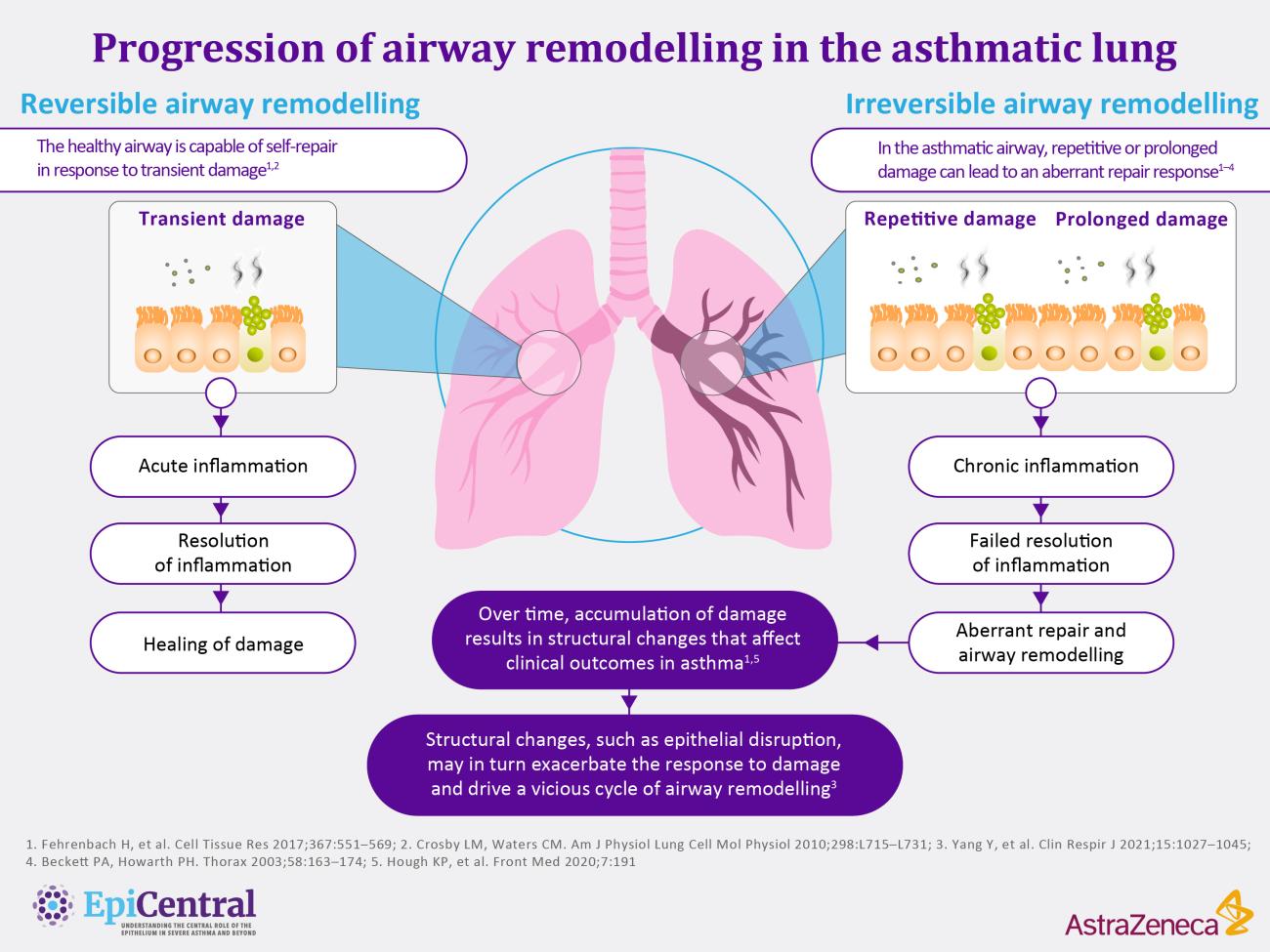 Irreversible remodelling infographic